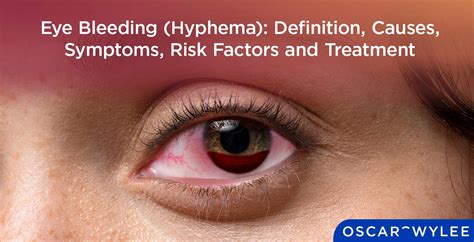 blood leaking from eye|Hyphema (Bleeding in Eye)